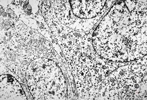 F,44y. | carcinoid - lung